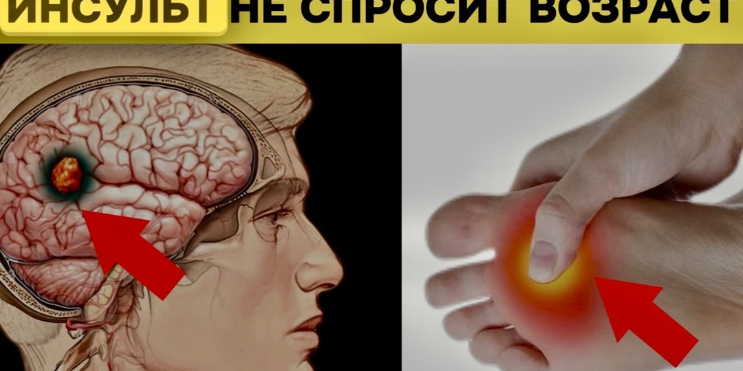 Тихий инсульт: когда мозг посылает неочевидные сигналы