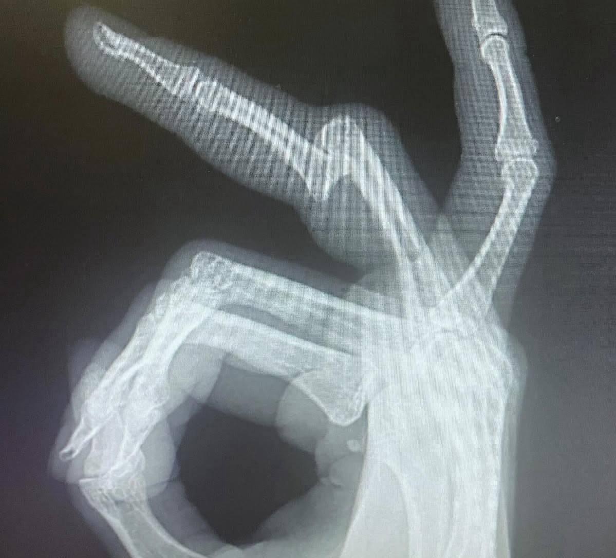 рентген пальцев Вероники