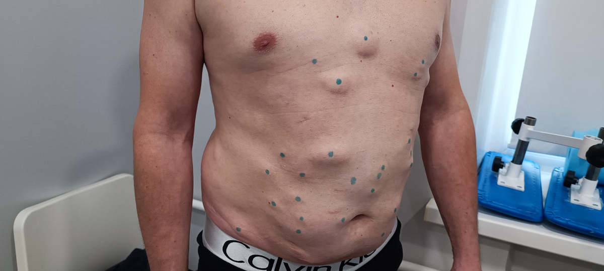 Липоматоз - множественные липомы