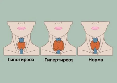 Эндокринолог объяснил, когда не нужно лечить гипотиреоз. Когда таблетки только навредят