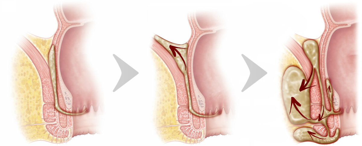 Воспаление затрагивает больше тканей и гной заполняет всё больше пространства