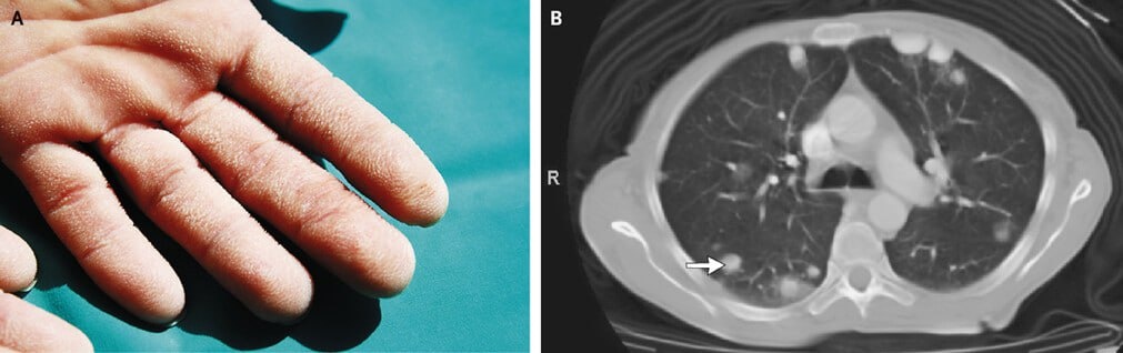 симптом "бархатной руки"