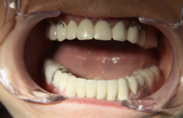 В обычной ситуации организм может это терпеть годами. Но при диабете баланс нарушается быстрее.