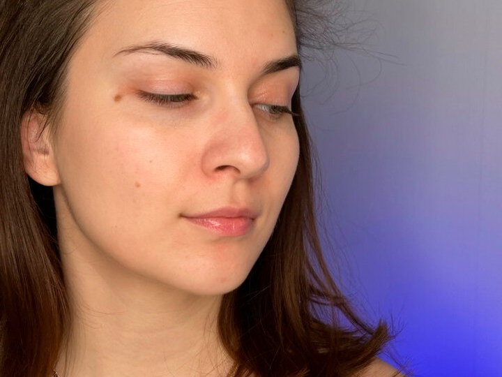 Растворяются ли спикулы (микроиглы) в коже? И как долго они там остаются?