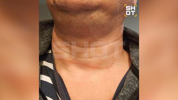 След от верёвки на шее туриста из РФ. Фото © Telegram /SHOT