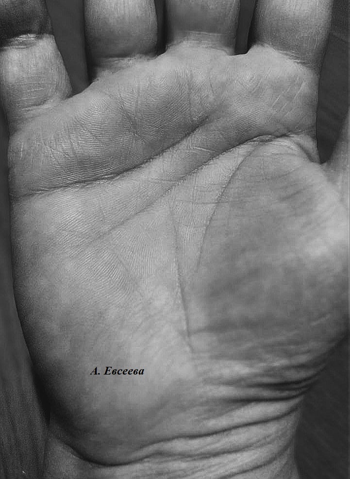 Руки 54-летней Г., которая перешагнула сложный период после 40 и продолжила движение по Линии Судьбы, заменившей ей Линию Жизни.