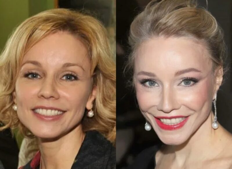    Преображения Марины Зудиной: до и после косметологических процедур.