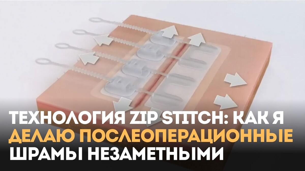 Технология Zip Stitch как я делаю послеоперационные шрамы незаметными