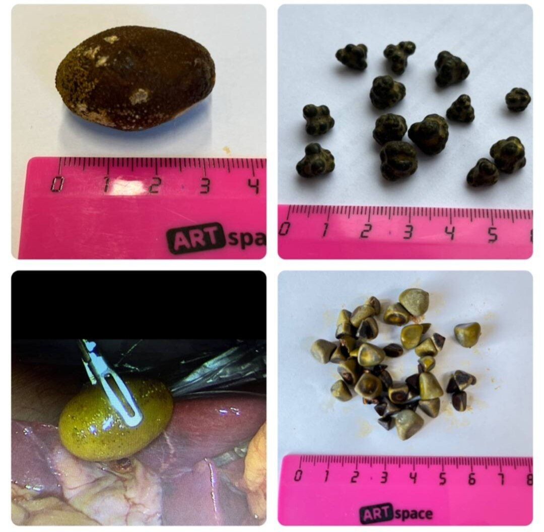 #холецистолитотомия 