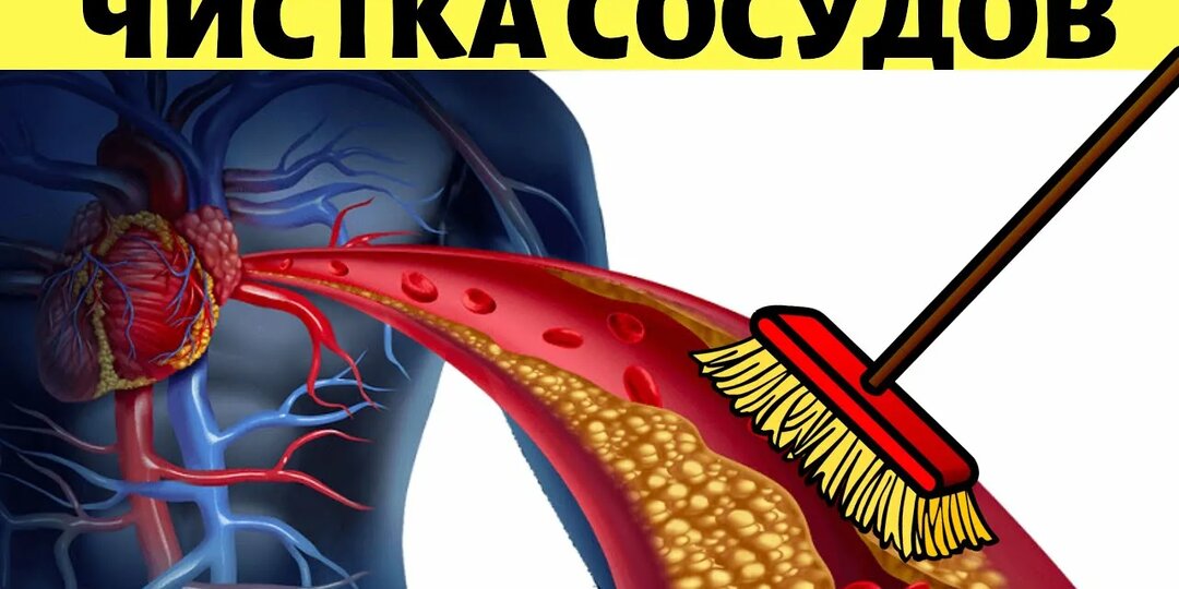 Можно ли очистить сосуды от бляшек без операции? Что говорит медицина - подробный разбор