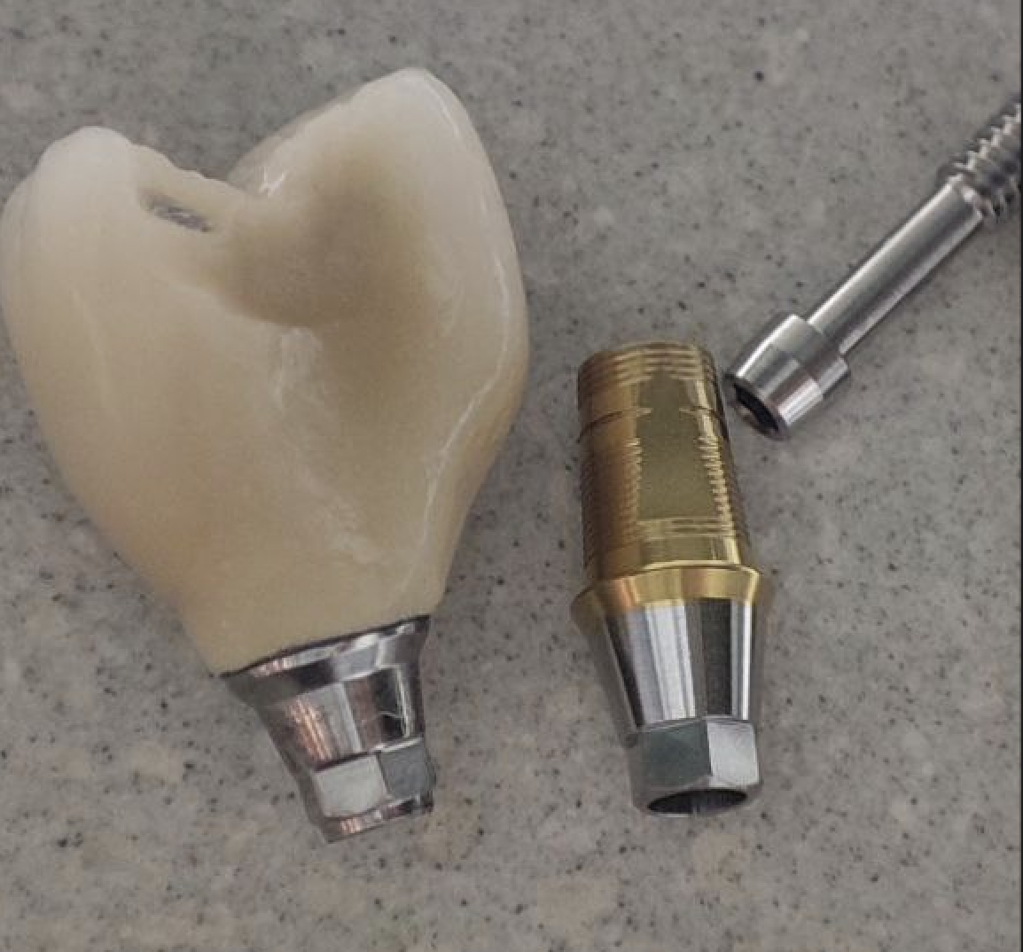 Даже простому обывателю видно, что это две абсолютно разные конфигурации и качественного прилегания добиться с данной формой невозможно. Еще на этой фотографии можно рассмотреть вмятину в коронке, которую пришлось делать технику, чтобы вписать пломбу соседнего зуба в коронку