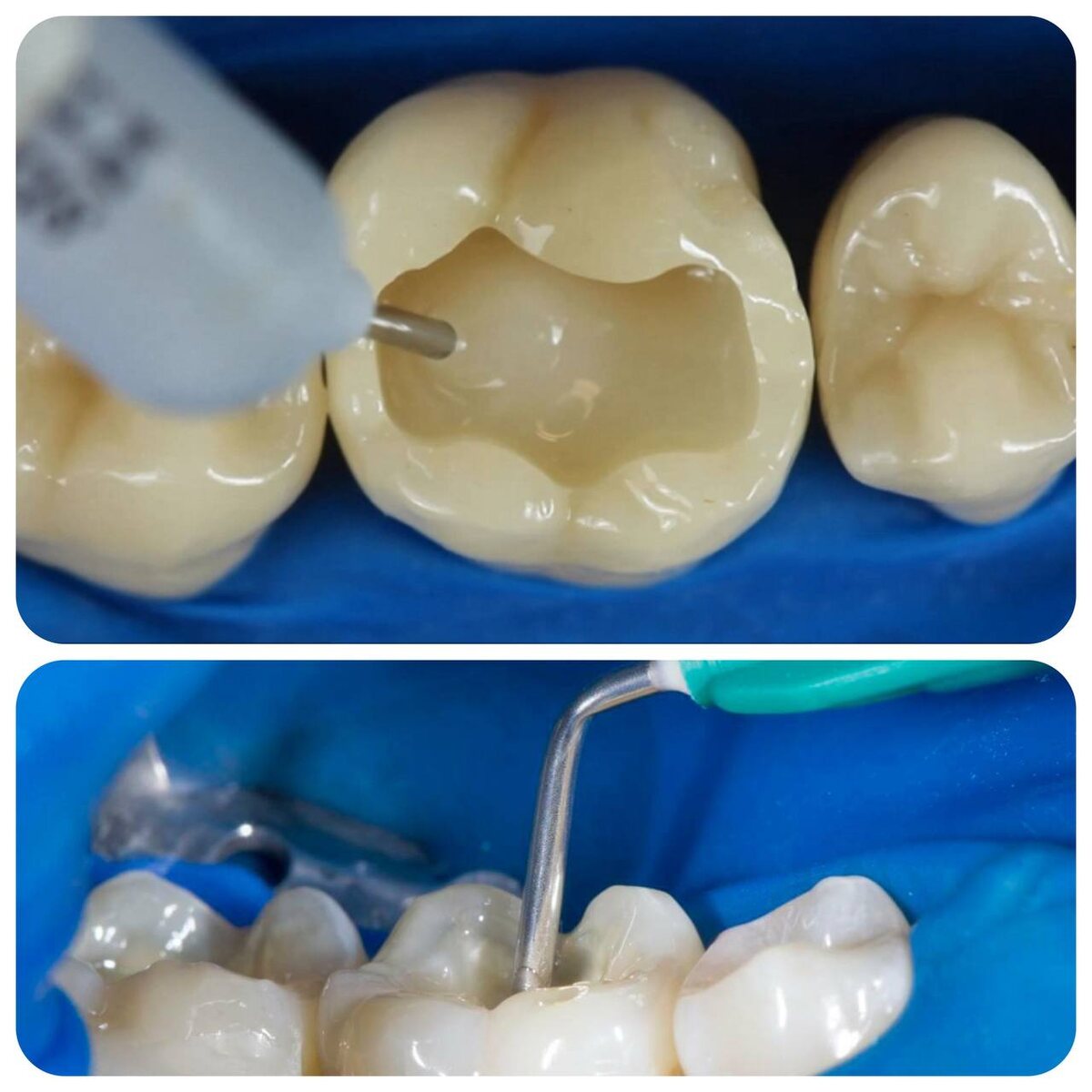 Пломба это хорошо, но не всегда