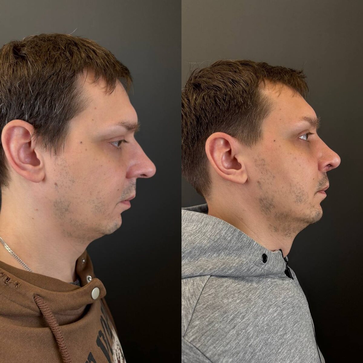 Риносептопластика: 1 месяц после операции. Хирург Остринская Т.В. (слева- до, справа- после)