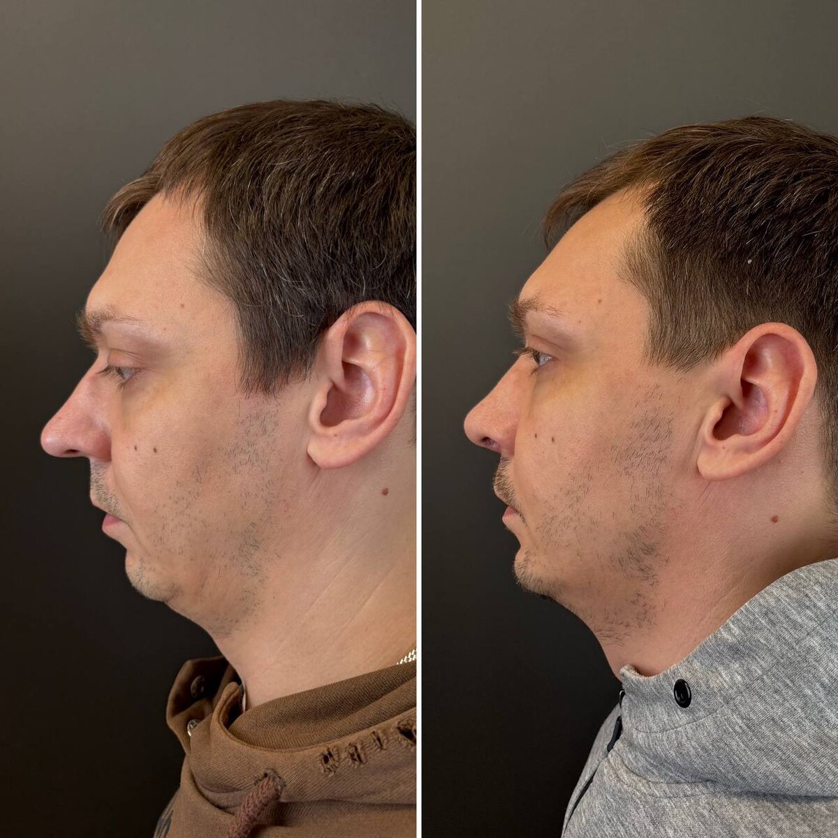 Риносептопластика: 1 месяц после операции. Хирург Остринская Т.В. (слева- до, справа- после)