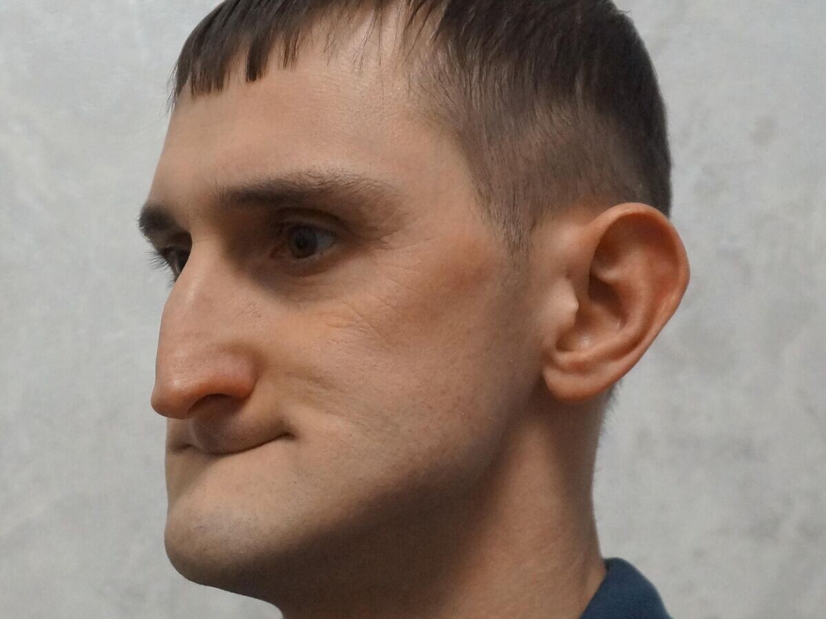    После удаления всех зубов у Андрея запала челюсть | © Фото предоставлено Андреем Муллиным