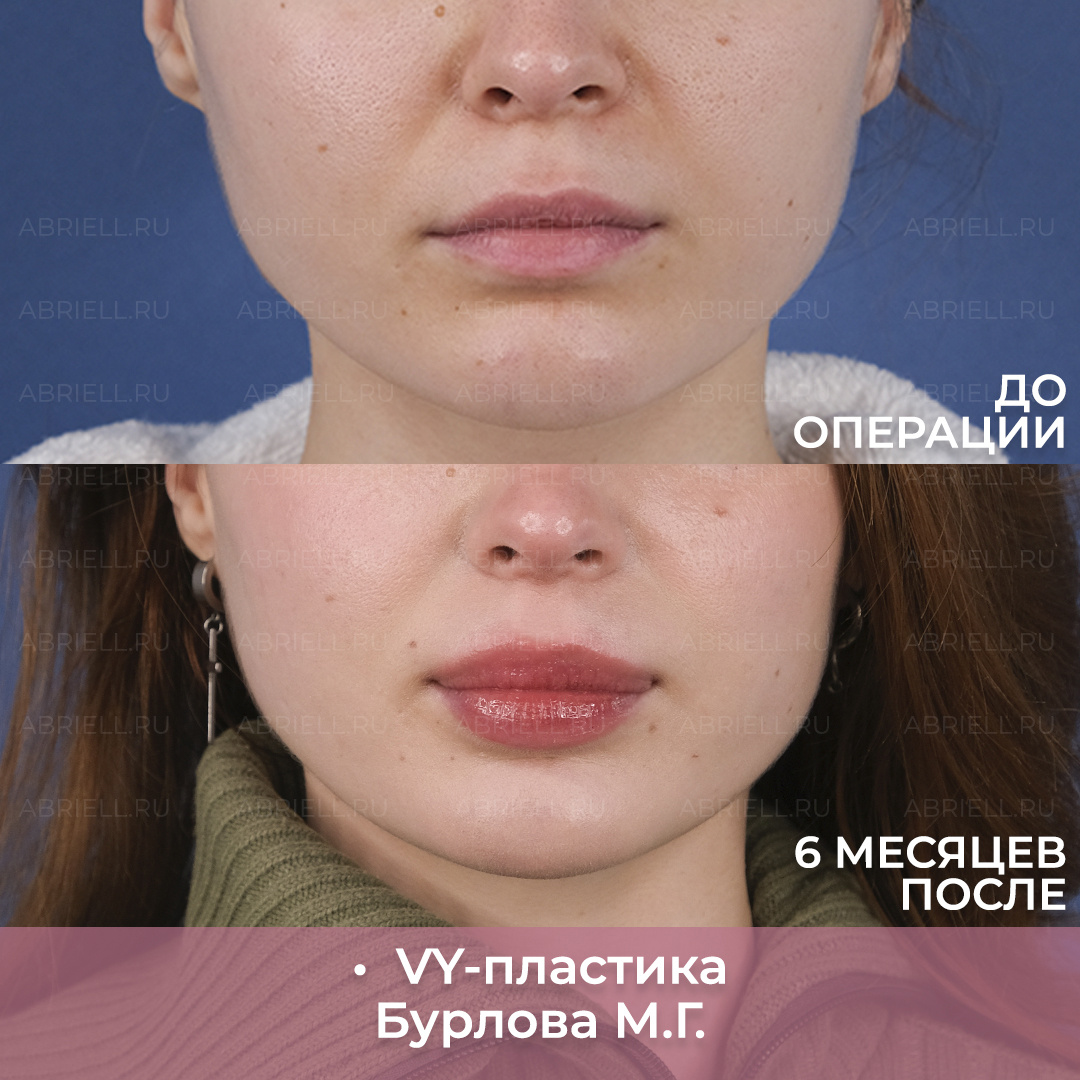 Увеличение губ VY-пластика без филлеров и навсегда / Бурлова Мария Григорьевна Пластический хирург в Санкт-Петербурге клиника Абриелль 