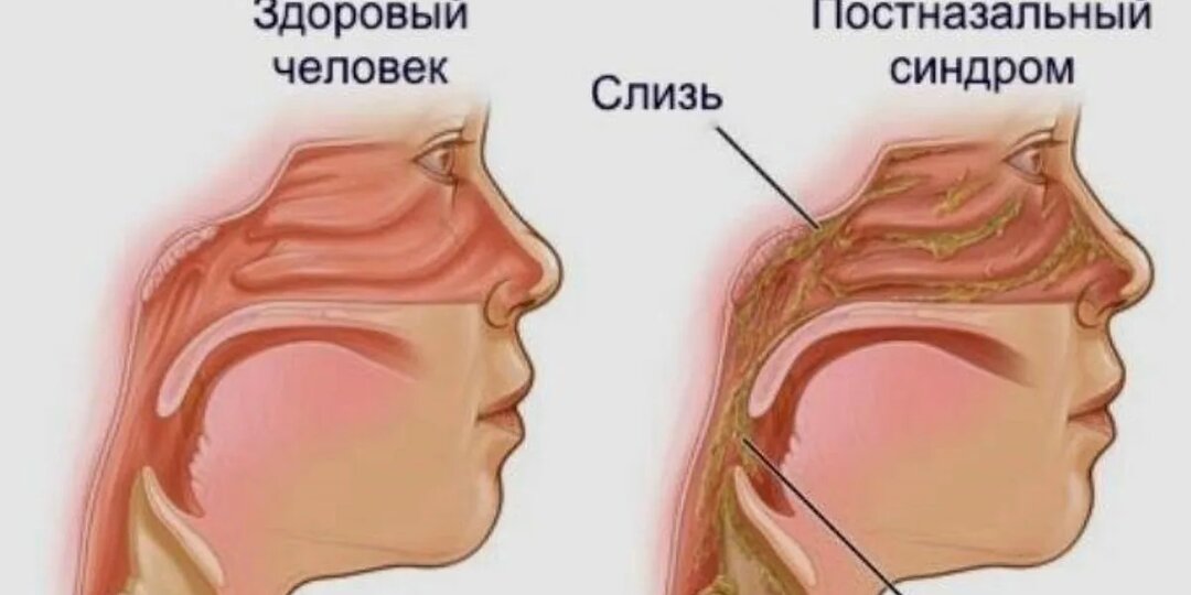 Постоянная слизь в носоглотке. Что как и почему: как разорвать замкнутый круг и наконец-то дышать свободно