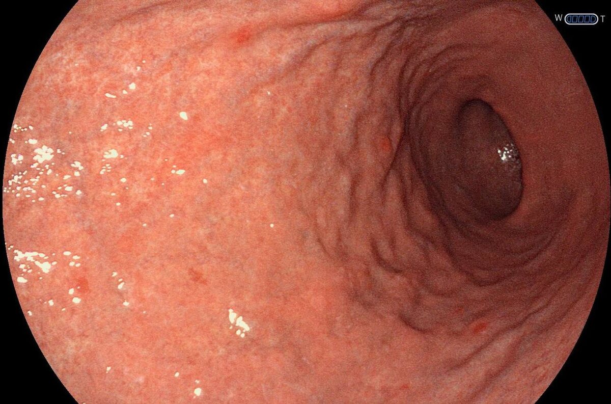 Пациент с аутоиммунным гастритом, фото 2–7