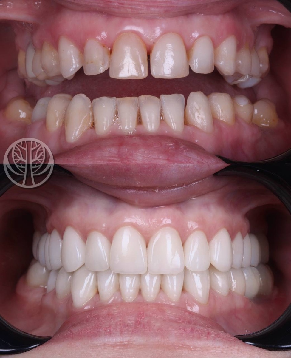 В/ч Emax press с нанесением массой Emax Ceram