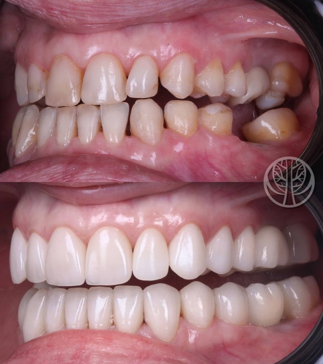 Н/ч Emax press с нанесением массой Emax Ceram и моляры полная анатомия.