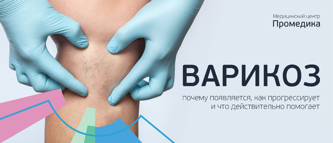 Варикоз: почему появляется, как прогрессирует и как лечить