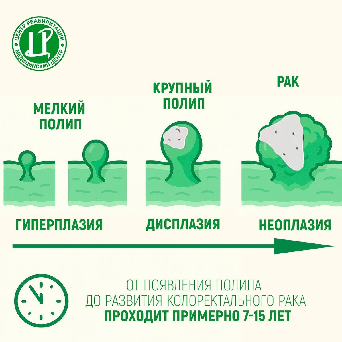 Процесс перерождения полипа в колоректальный рак занимает, в среднем, от 7 до 15 лет