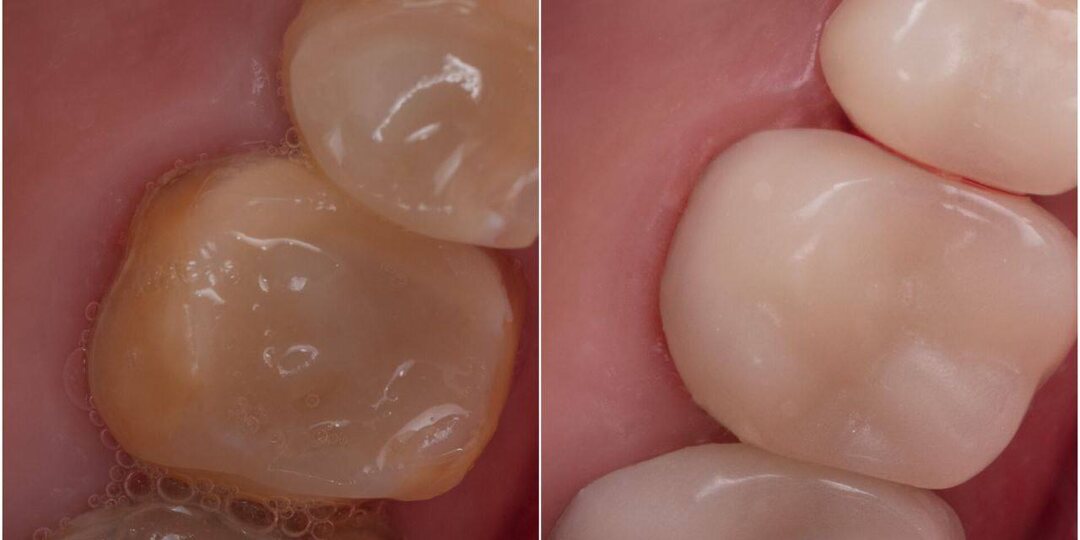 Иногда зубам требуется временная защита, особенно в случаях, когда необходимо наблюдать за состоянием зуба или на этапе ортодонтического