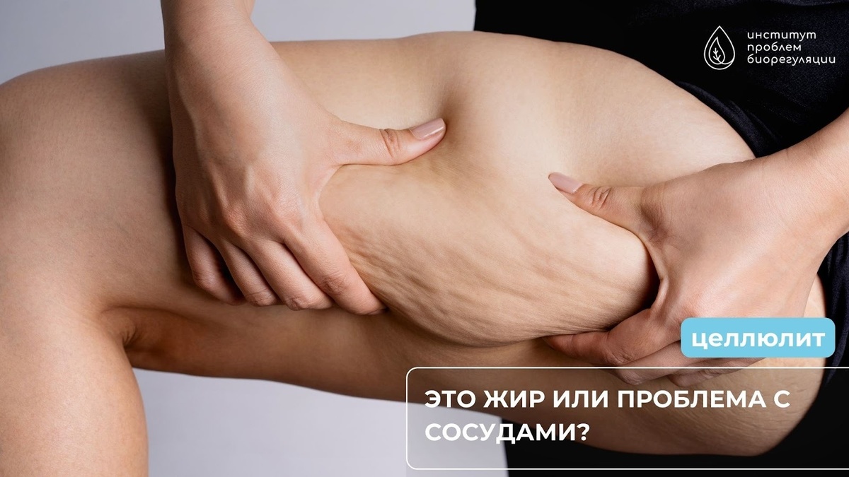 Целлюлит: это жир или проблема с сосудами?