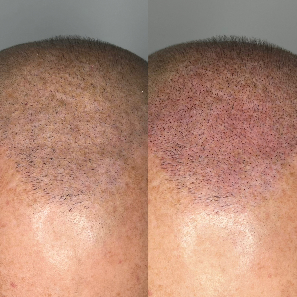 Результат после 1 сеанса трихопигментации по методу SMP