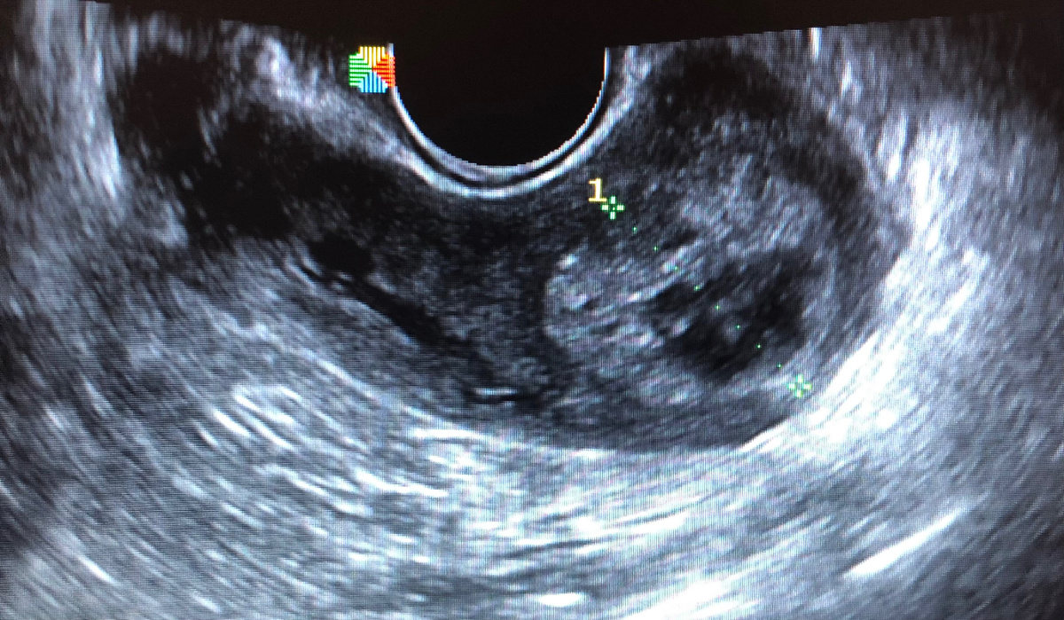 Эхо-картина остатков плодного яйца после аборта