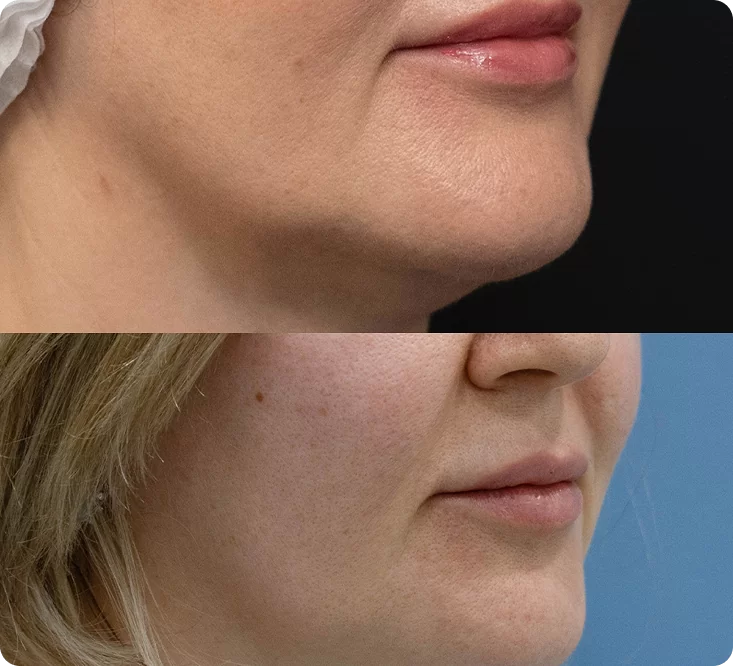 Реальный результат нашей клиентки после процедуры Morpheus 8 