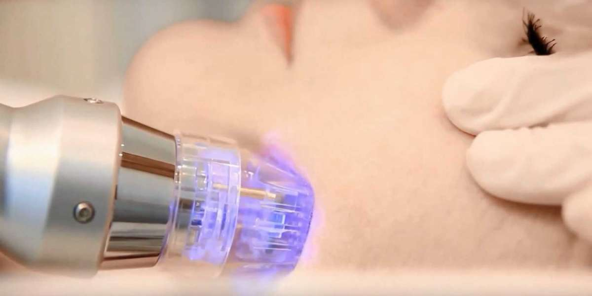 Morpheus 8 работает глубже и даёт более выраженное уплотнение и подтяжку, чем классический RF, но требует восстановления и чётких показаний.