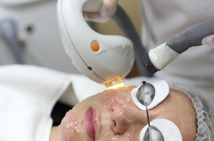 Фотоомоложение M22 (IPL на платформе Lumenis) помогает выровнять тон кожи, уменьшить пятна и красноту и сделать лицо визуально свежее без тяжёлой реабилитации.