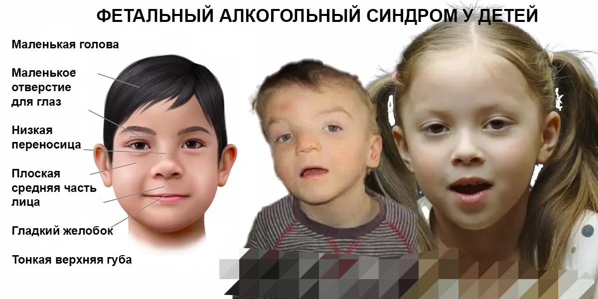 Дети, пьющих во время беременности матерей, имеют фетальный алкогольный синдром 