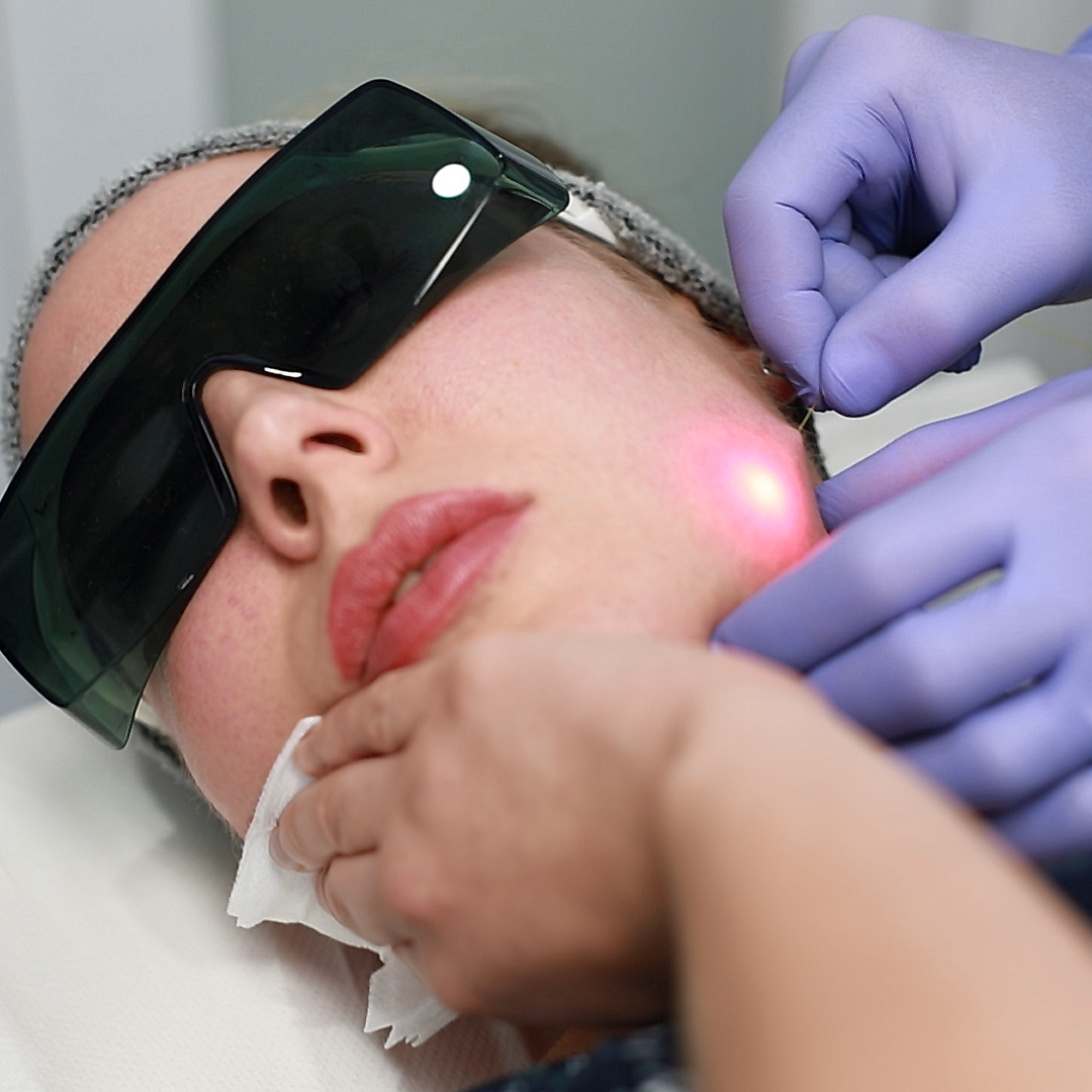 Липоредукция подбородка помогает убрать локальный жировой «карман» и вернуть чёткость овала лица без операции и длительной реабилитации.