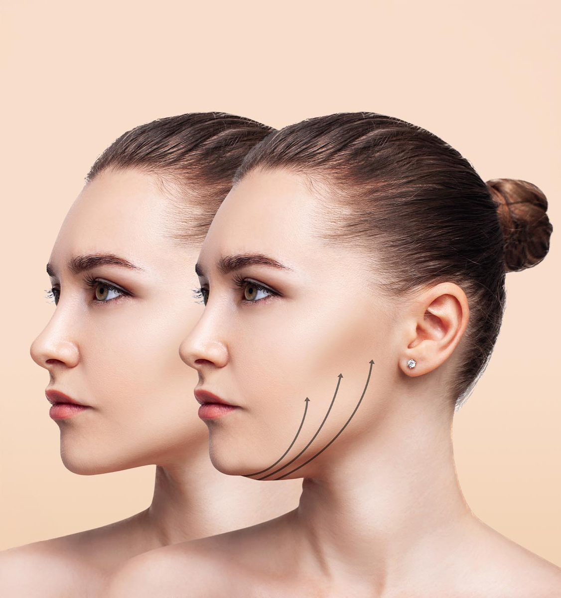 Подбородок часто относится к «жировым ловушкам»: даже при снижении веса объём в нижней трети лица может сохраняться из-за особенностей распределения жира.