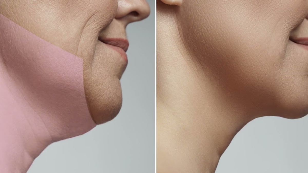 Второй подбородок может появляться независимо от веса и возраста, потому что часто связан с локальным жиром и анатомией, а не только с образом жизни