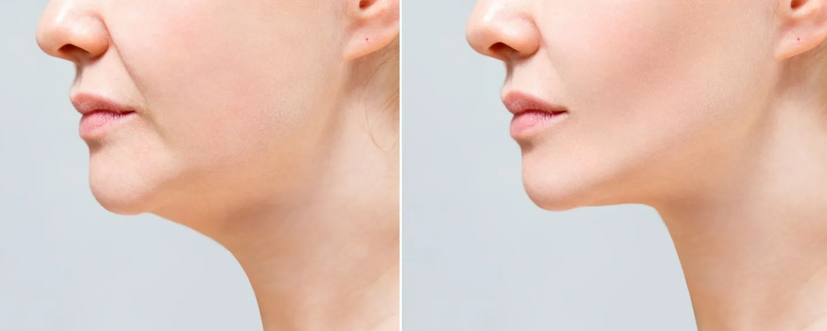 Липоредукция подбородка — это не «большая операция», а контролируемая медицинская процедура с понятным протоколом и прогнозируемым результатом.