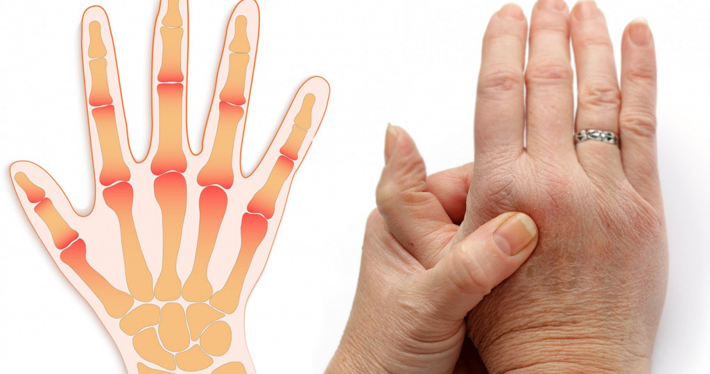 Болят пальцы? Возможно, это совсем не артроз. Полный разбор причин, которые упускают из виду