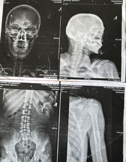 Как мы доказали основание для списания по военной травме и тяжелому ранению. От военной травмы до категории «В»