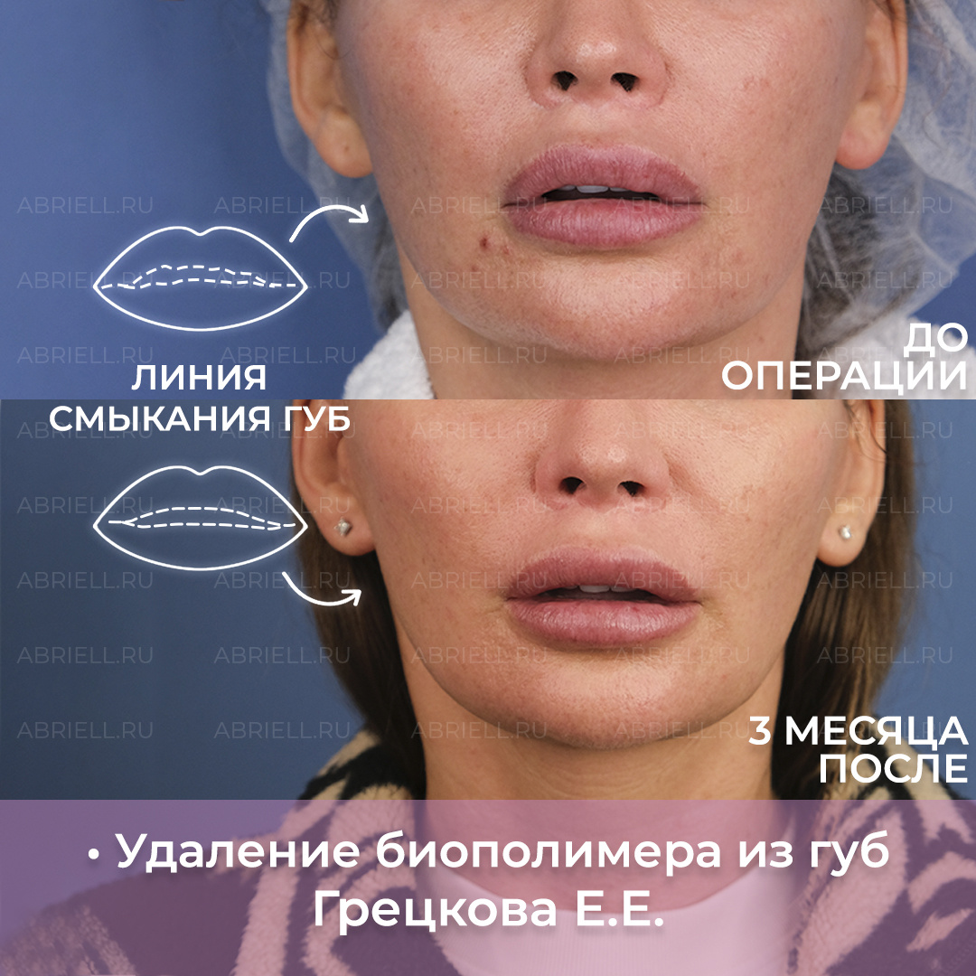 До после, результат удаления биополимера из губ в Санкт-Петербурге / Грецкова Евгения Евгеньевна Пластический хирург Клиника Абриелль 