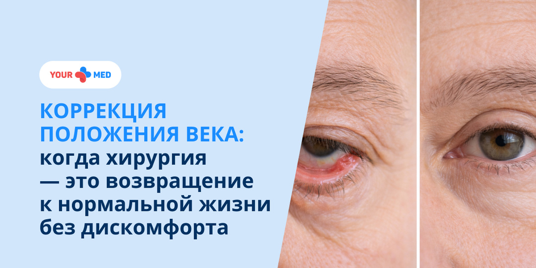 Коррекция положения века: когда хирургия — это возвращение к нормальной жизни без дискомфорта
