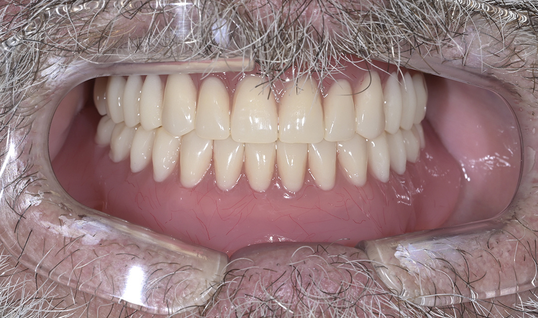 Результат протезирования в стоматологии Денталюкс