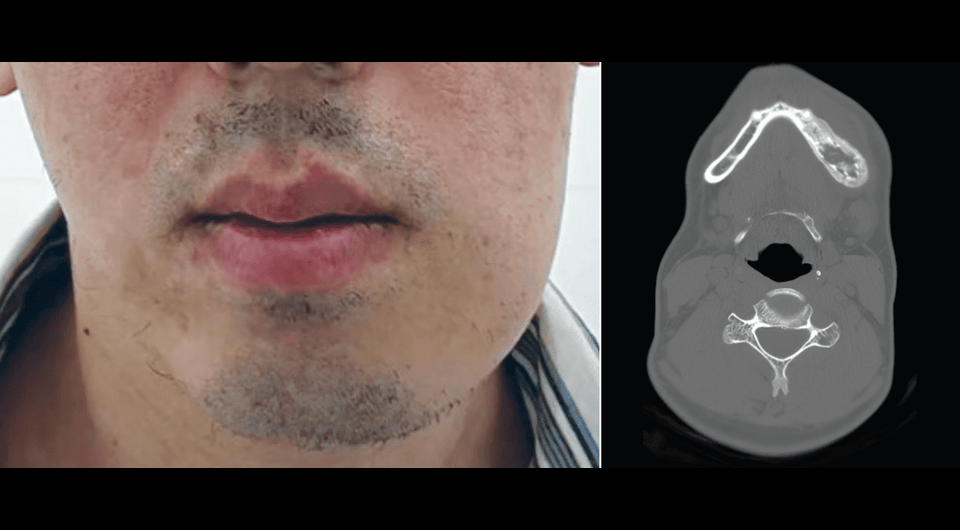   Kaili Yang et al. / JAMA Otolaryngology — Head & Neck Surgery, 2026