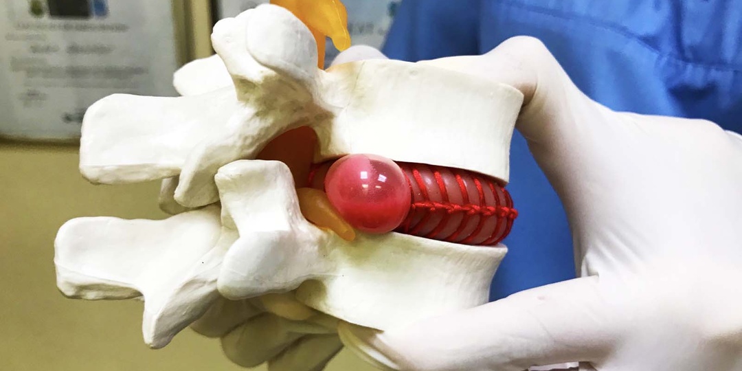 Как организм сам избавляется от грыжи позвоночника