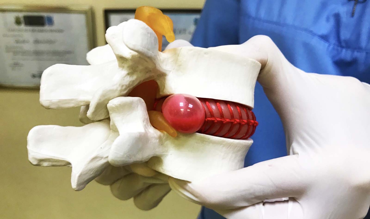 Грыжа позвоночника