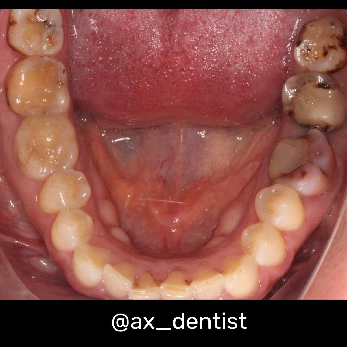 Нижний шестой зуб окрашен резорцион-формалином