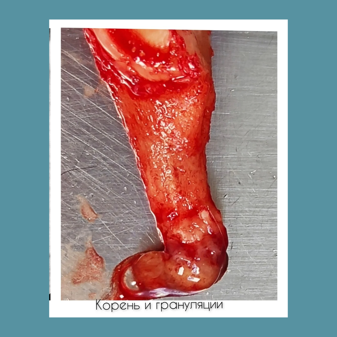 апикальная киста. зуб секционирован