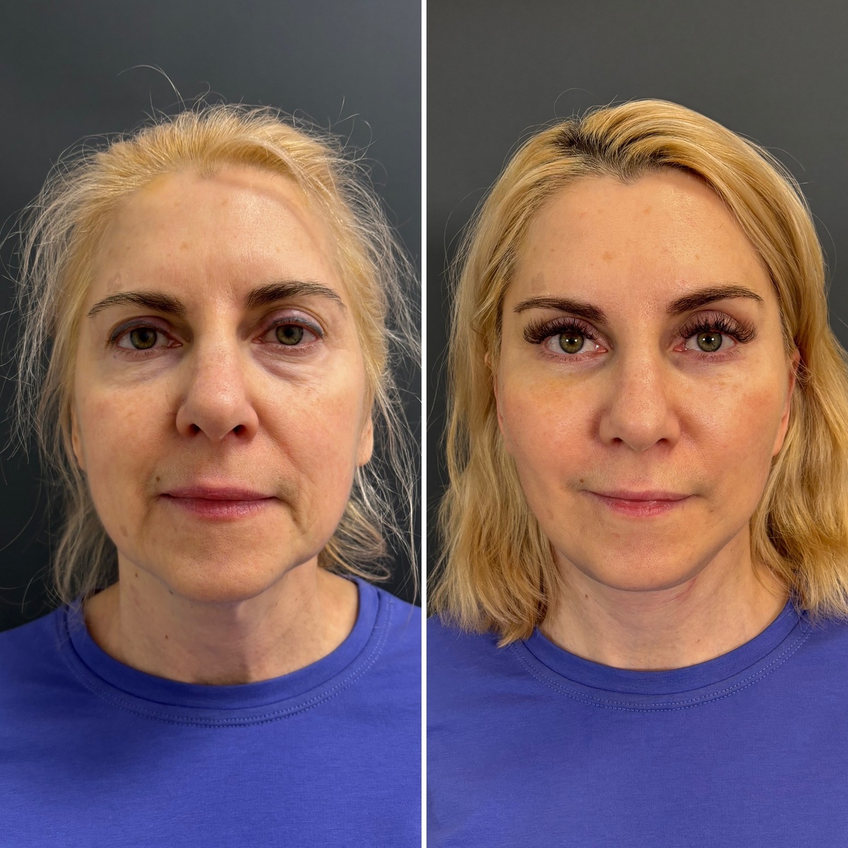 Комплексное омоложение лица: 1 месяц после операции ( слева- до, справа- после). Хирург Остринская Т. В.