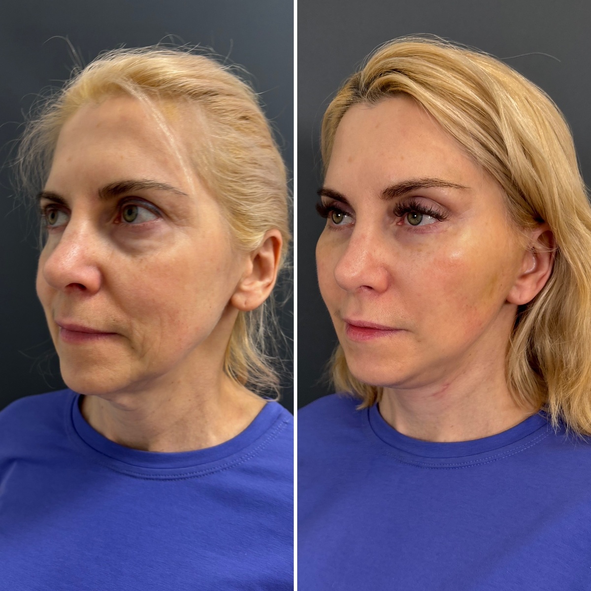 Комплексное омоложение лица: 1 месяц после операции ( слева- до, справа- после). Хирург Остринская Т. В.